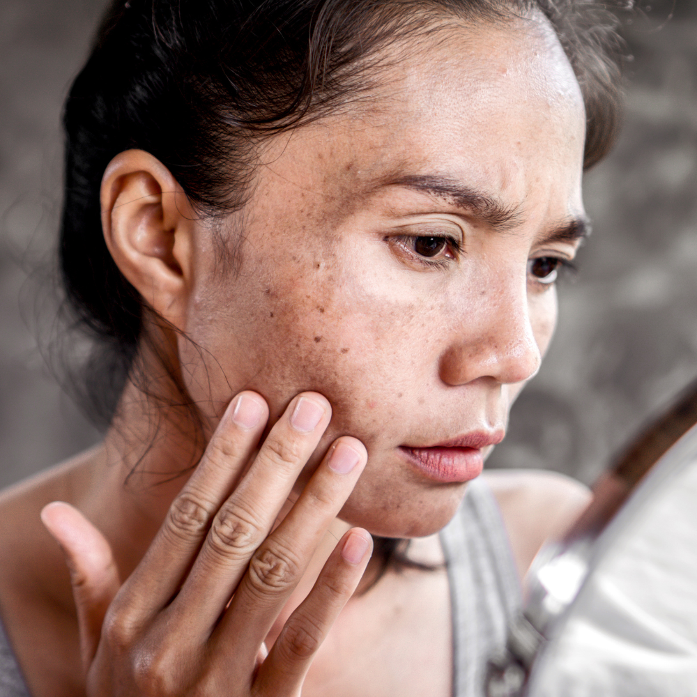 Pigmentation & Uneven Skin Tone